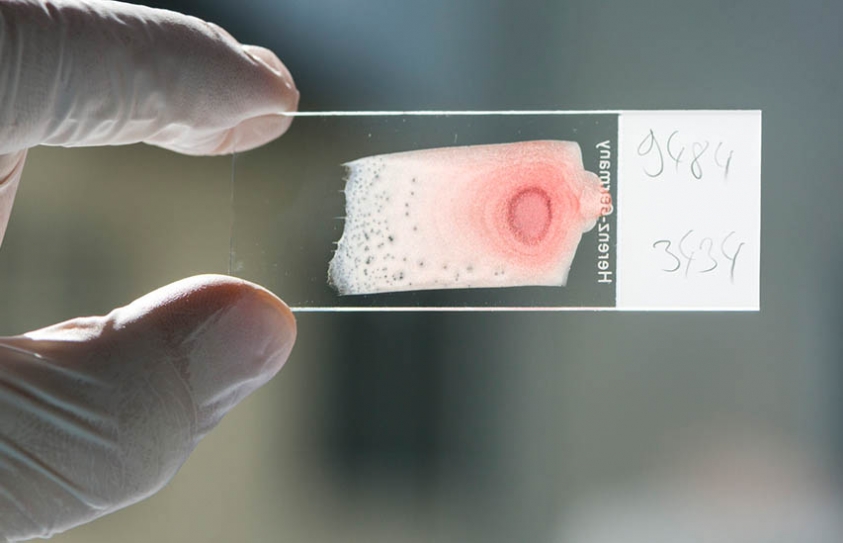 A Pinprick To Detect Cancer 