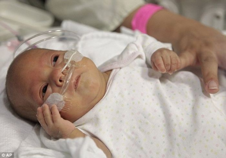 Premature babies: How 24 week-old babies are now able to survive