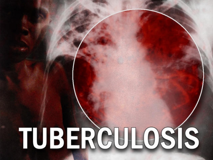 India initiates process to formulate guidelines for TB