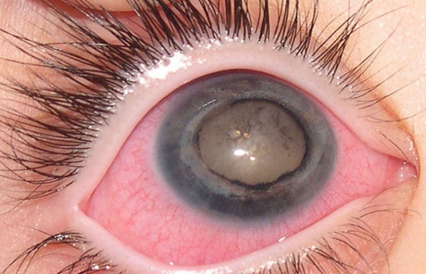 rare eye conditions
