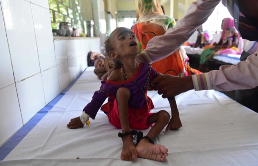 Paediatricians Demand Preventive Policy For SAM Children 
