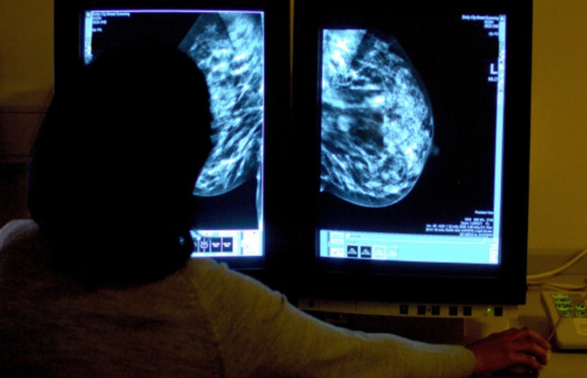Statins Could Reduce Risk Of Breast Cancer Deaths By 38%, Research Shows 