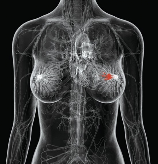 Tackling a Racial Gap in Breast Cancer Survival