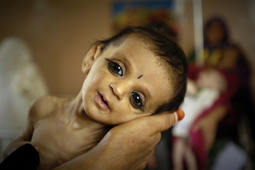 For an aspiring global power, India suffers from shocking levels of malnutrition
