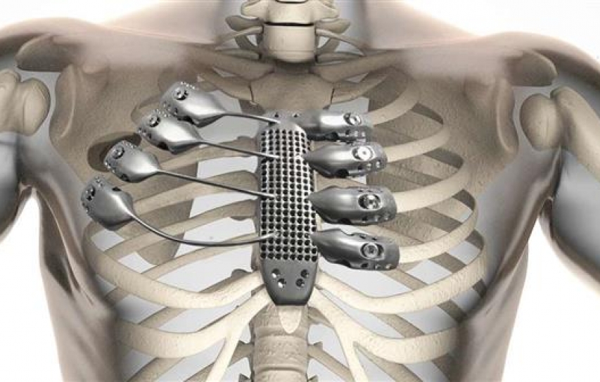 3D Printing Helps Surgeons Plan Life-Saving Operation