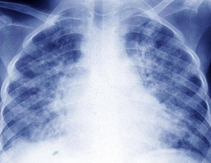 Global Fight Against Tuberculosis Hinges On India Stepping Up Funding: WHO