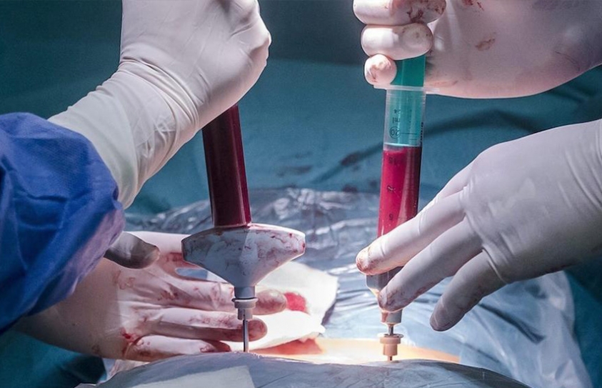 Stem Cell Injections To The Brain Could Help Stroke Patients Regain Mobility