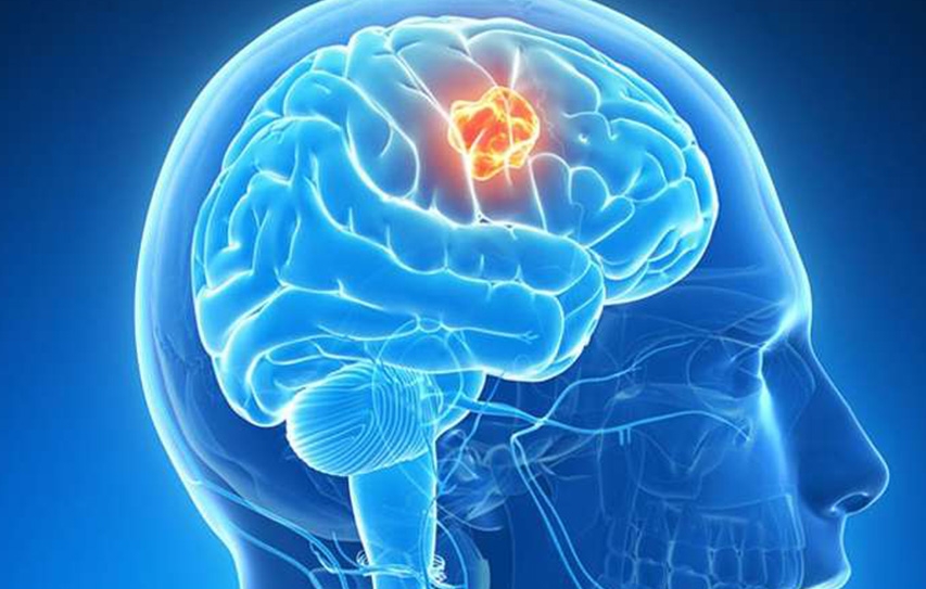 Over 2,500 Indian Kids Suffer From Brain Tumour Every Year