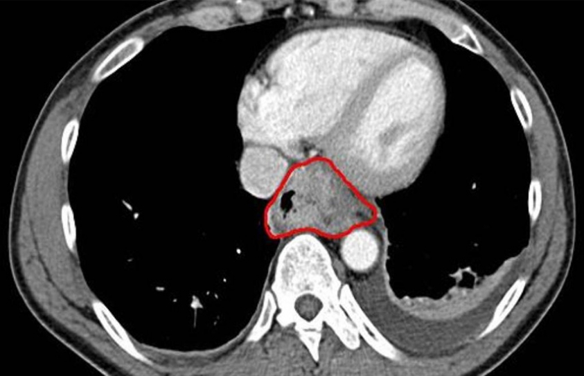 This Computer Program Detects Cancer Earlier Than Ever—Without Surgery